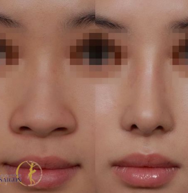 Thẩm mỹ viện chuyên nhận sửa các ca thẩm mỹ mũi bị biến chứng
