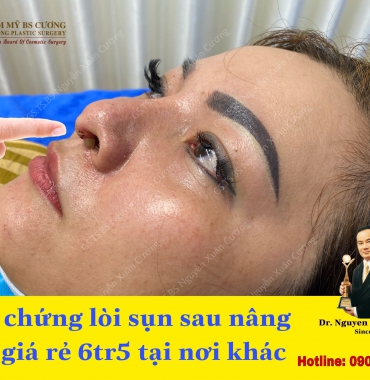 Bác sĩ chuyên sửa các loại thẩm mỹ mũi bị xấu, bị hư hỏng khi thực hiện tại nơi khác