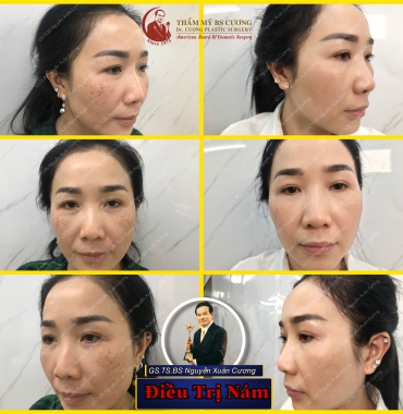 Câu chuyện diều trị nám da dứt điểm sau khi đã mất niềm tin vào các liệu pháp thẩm mỹ