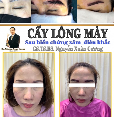 Chi phí cấy lông mày là bao nhiêu