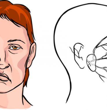 Điều trị bệnh liệt cơ mặt ở đâu thì dứt điểm và không có biến chứng