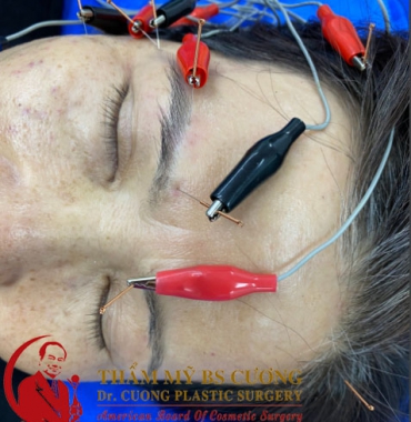 Điều trị liệt dây thần kinh số 7 dứt điểm mà lâu năm trị không hết