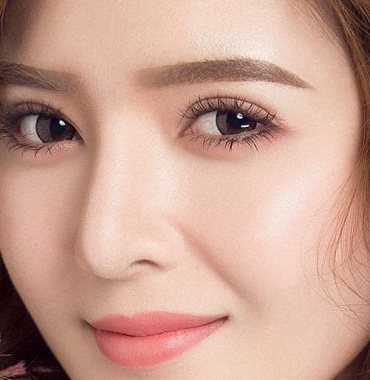 Hiệu quả đẹp bất ngờ từ phẫu thuật mở rộng khóe mắt