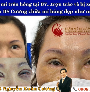 Nhận chỉnh sửa phục hồi các trường hợp cắt mắt 2 mí bị hỏng, bị dị tật