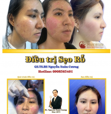 Sự thật về  điều trị sẹo rỗ bằng phương pháp cà da